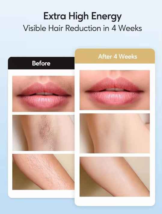 IPL Hair Removal Device with Ice Cooling Care Function for Women - 999,999 Flashes Painless Permanent Hair Remover